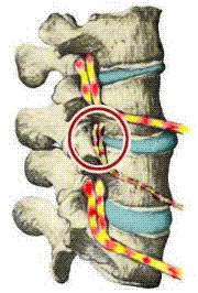 Subluxations