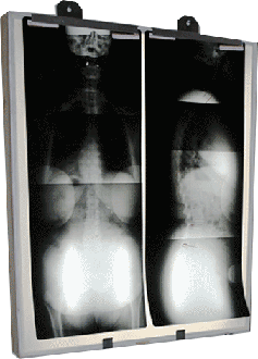 X-Ray